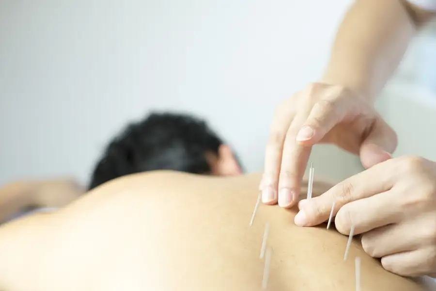 Acupuncture Treatment